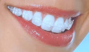 Orthodontics (Clear Brackets)